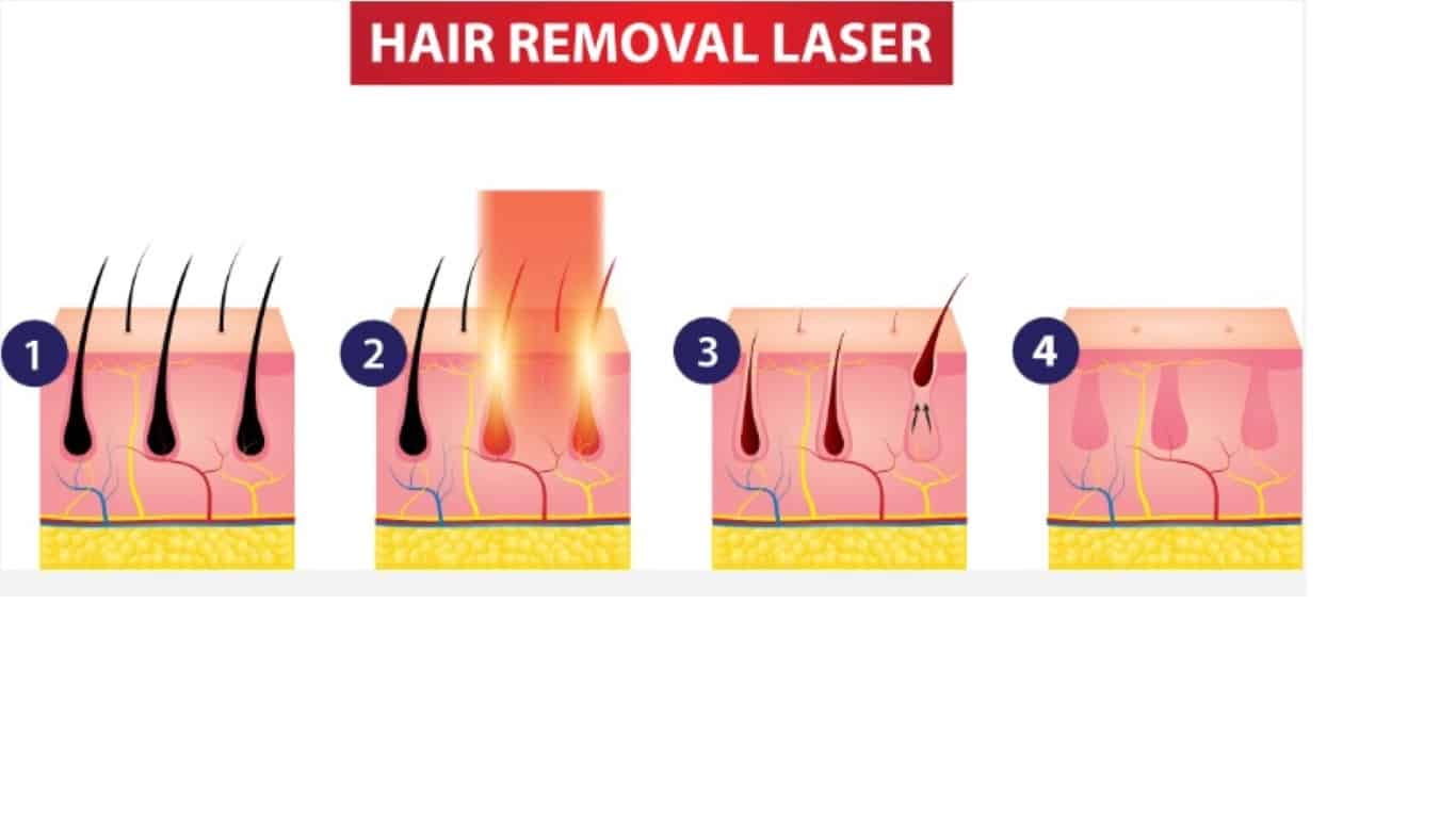 μπορω να ξυριστω μετα το laser